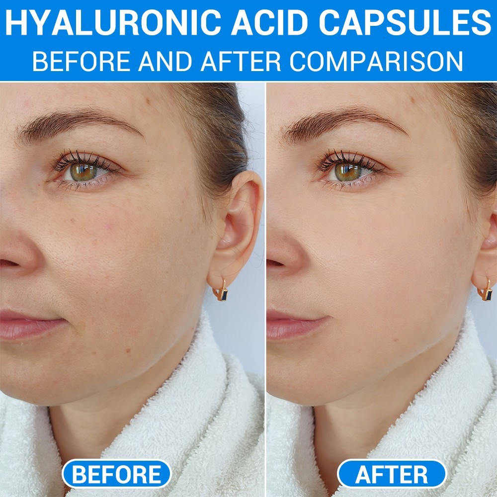 Hyaluronic Acid Anti Aging Hydrating Capsules Wrinkles Fine Lines Joint Health.