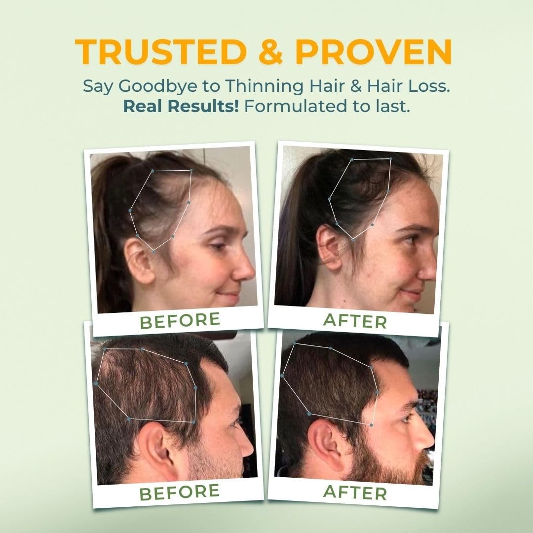 VITAL NUTRITIVE Vital Hair Complex – Biotin & Vitamin B Hair Vitamins for Wom…