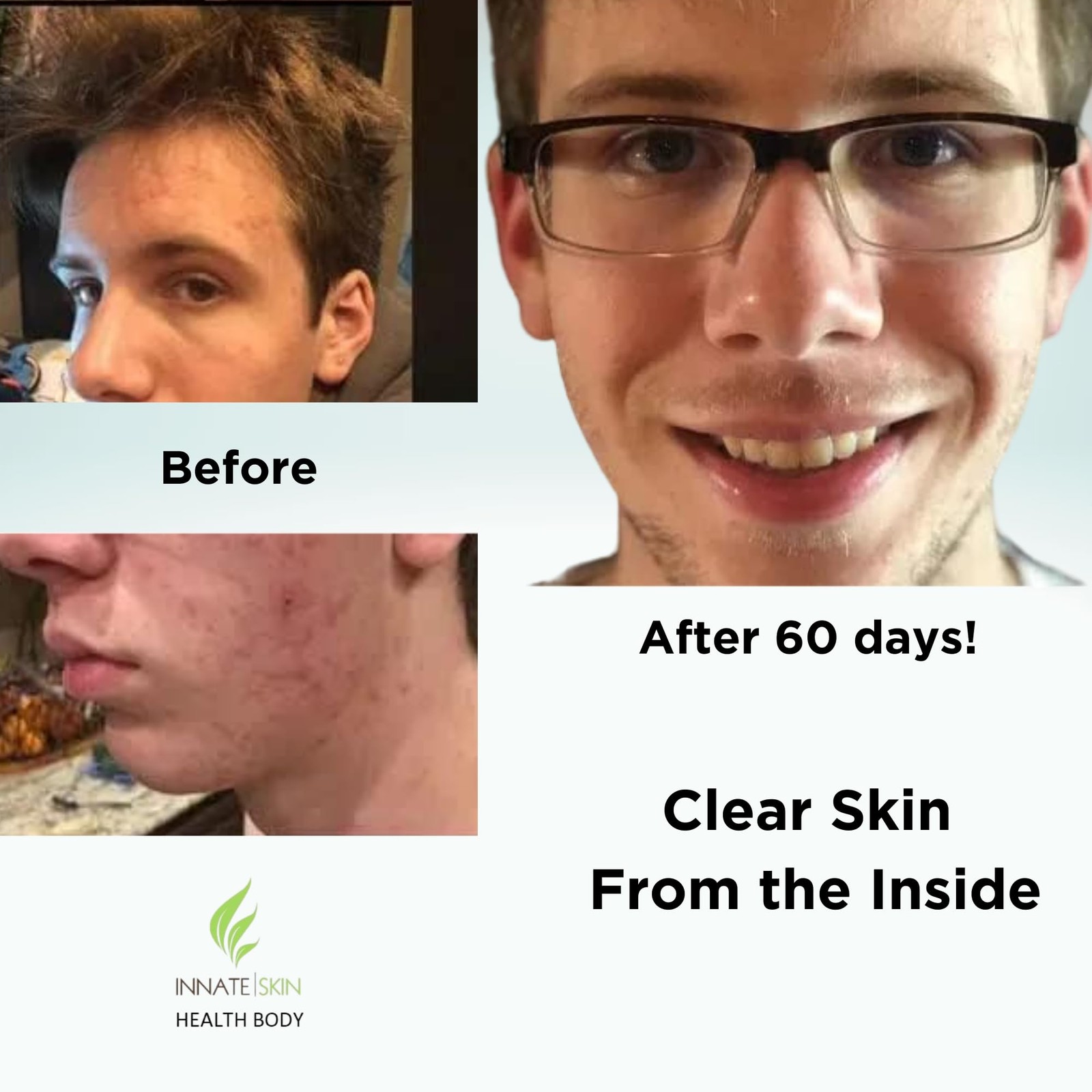 Clear Skin Acne Vitamin System | 20 Antioxidants, 60 Count (Pack of 2)